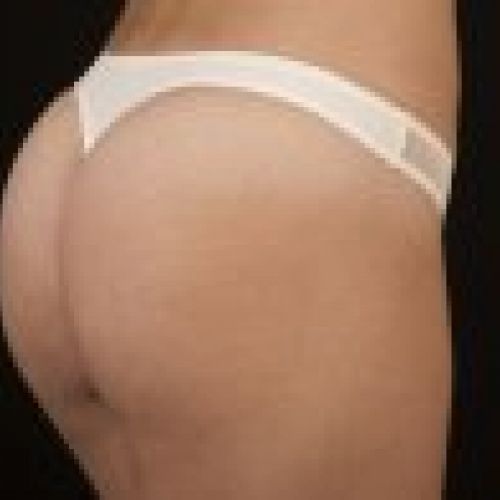 TANGA 608 ESMERALDA